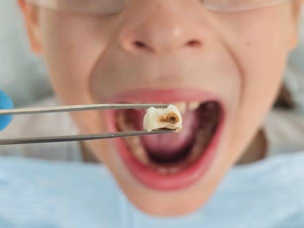 Best Emergency Dentist for Lost Fillings or Crowns in Pittsboro, NC